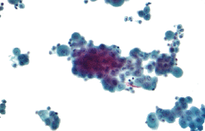Microscopic Fluid Sample, Mesothelioma Cytology | What Is Mesothelioma Cytology?
